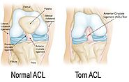Anterior Cruciate Ligament (ACL) Inujry - Causes, Symptoms, Treatment - Mahi Clinic