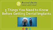 5 Things You Need to Know Before Getting Dental Implants