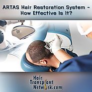 Hair Transplant Network — ARTAS Hair Restoration System - How Effective Is...
