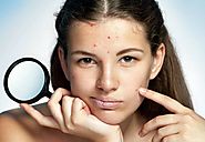 How to Cure Acne: 4 Secrets to Help You Get Rid of Acne Naturally