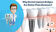 Why Dental Implant Bridges are Better than Dentures?