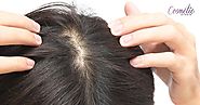Follicular Unit Extraction – The Best Hair Transplant Treatment