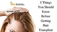 5 Things You Should Know Before Getting Hair Transplant