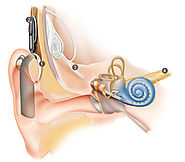 Cochlear implants & cochlear implant technology