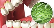 Vitamin D and Two Most Common Diseases of Teeth