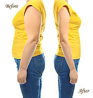 Tummy Tuck to boost Weight Loss