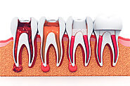 Which Treatment is a Better: Root Canal or Tooth Extraction?