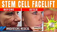 Stem Cell Facelift Before & After (50 and gets carded for ALCOHOL)