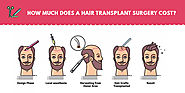 How Much Does a Hair Transplant Surgery Cost ?