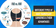 Hair Transplant Surgery Types and Their Advantages