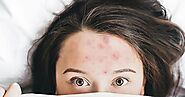 Guam Medical Clinic for Acne Treatment - Acne Scar Specialist