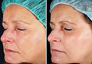 Laser Skin Tightening – Eliminate Various Skin Imperfections | Fashion Copys