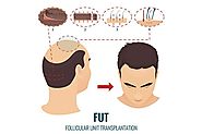 Is hair transplantation a permanent solution? - Quora