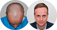 Everything you want to know about Hair Transplants | Hair Loss | Harley Street Hair Clinic