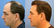 This is what you need to know about FUE Hair Transplant