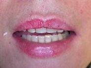 10 best Desired Smiles images on Pinterest | Cosmetic dentistry, Dental and Dentistry
