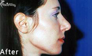 What is the Best Nose Job Before and After Testimonial in Croatia?