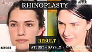 Beautiful Transformation - Piezo Ultrasonic Rhinoplasty | Kyra Aesthetic Clinic