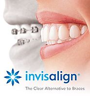 Invisalign Dentistry Assist You to Smile Confidently Again