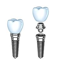 Replace Your Damaged Teeth With Dental implant Services – San Marcos Dentist for Everyone in Your Family