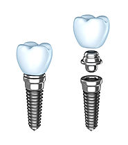 Hire Affordable Dental Implants Services