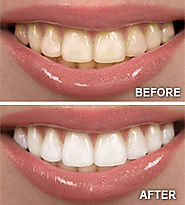 Cosmetic Teeth Whitening Services For Making A Heart Melting Smile!