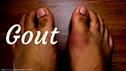 Approach to inflamed joint in the ED. Gout vs septic joint, and common clinical questions