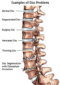 Treatment for Disc Herniation in Augusta GA