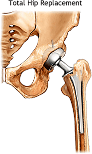 Total Hip Replacement Great Surgical Advances Over the Last Century