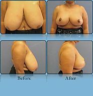 Breast Reduction Richmond