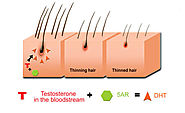 What is DHT & its link with hair loss