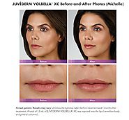 Lips with Lip Fillers at Anderson MedSpa