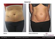 A Comfortable, Non-Invasive Option for Body Contouring