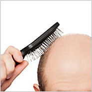 What is FUT Hair Transplant and How Does it Works?
