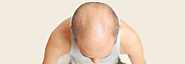 The Relevance of Male Pattern Baldness Treatment with Hair Transplant