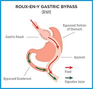 Consult Dr. Ravi Rao for Roux-en-Y Gastric Bypass Surgery in Perth