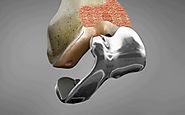 Knee Replacement Implant Material Pros and Cons - Lyfboat