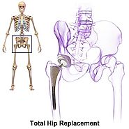 Hip Replacement In India - Cost, Hospitals, Surgeons - Lyfboat