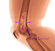 Bone Cancer Treatment in India With List of Best Bone Cancer Treatment Hospitals in India