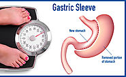 Best Gastric Sleeve Surgery in Cancun, Mexico