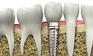 Affordable Dental Implants in Cancun