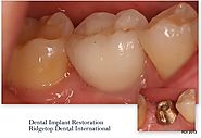 Implant Crown Restoration – Ridgetop Dental International