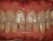 Orthodontist in Bangalore – Ridgetop Dental International