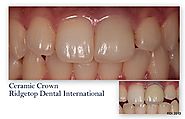 Dental Crown – Ridgetop Dental International