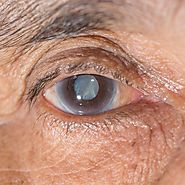 Cataract Surgery: When You Need to Get Diagnosed by an Ophthalmologist and What to Expect