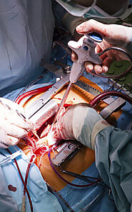 Heart Valve Surgery in Mumbai, Top Heart Surgeon in India