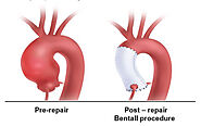 Aortic Root Surgery In Mumbai, Aortic Valve Replacement