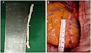 Coronary Endarterectomy, Heart Bypass Surgery Specialist In Mumbai