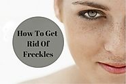 10 Best Home Remedies To Get Rid Of Freckles Permanently