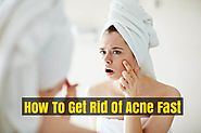 Most Useful Home Remedies To Get Rid Acne Fast - Best Acne Treatment